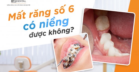 Có những phương pháp niềng răng nào phù hợp cho trường hợp mất răng số 6?
