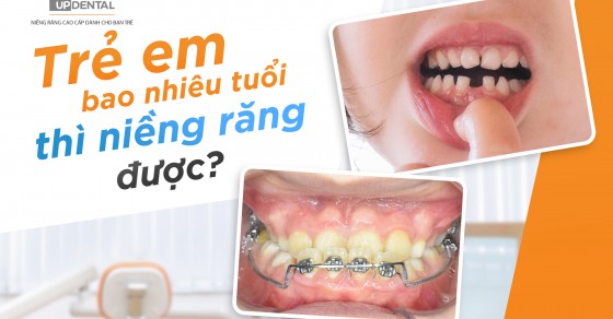 Điều gì xảy ra nếu trẻ em được niềng răng quá muộn?
