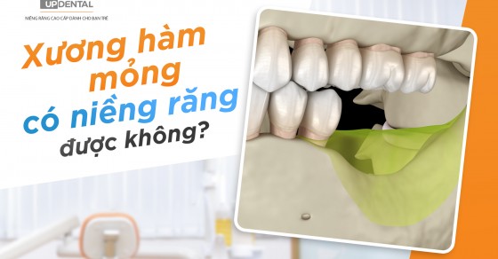 Xương hàm mỏng có thể niềng răng được không?