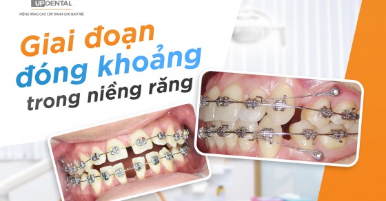 Làm thế nào để đóng các khoảng trống trên cung hàm khi niềng răng?
