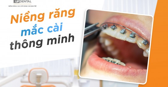 Nguyên lý hoạt động của niềng răng mắc cài thông minh là gì?
