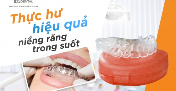 Những người nào nên sử dụng niềng răng trong suốt và có bao nhiêu thời gian cần sử dụng?
