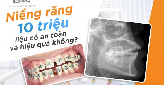 Mức giá niềng răng bằng phương tháo lắp dao động từ bao nhiêu đến bao nhiêu?
