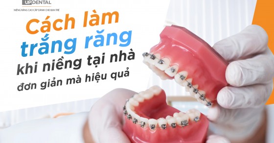 Cách Làm Trắng Răng Khi Niềng Tại Nhà đơn Giản Mà Hiệu Quả Up Dental 