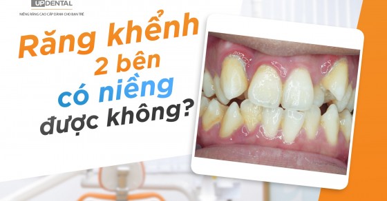 Răng khểnh 2 bên có thể di truyền không? Nếu có, liệu con cái có khả năng thừa hưởng tình trạng này từ cha mẹ hay không?
