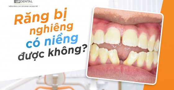 [Giải đáp thắc mắc] Răng bị nghiêng có niềng được không? | Up Dental