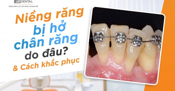 Có những bước điều trị nào cho viêm lợi hở chân răng?
