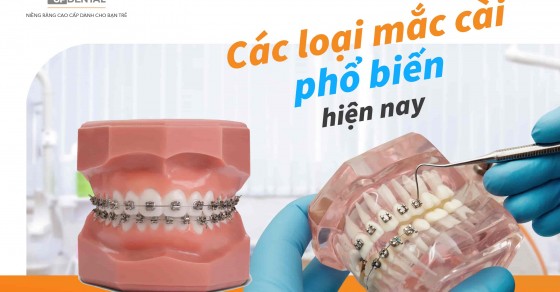 Các loại mắc cài niềng răng phổ biến nhất hiện nay | Up Dental
