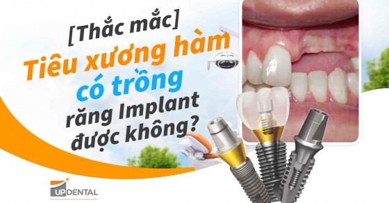[Thắc mắc] Tiêu xương hàm có trồng răng Implant được không? | Up Dental