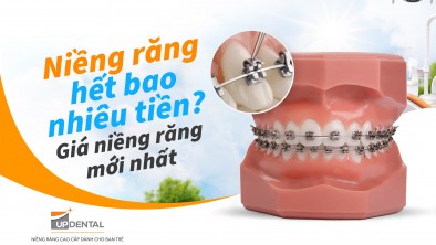 Niềng răng bao nhiêu tiền [05/2026]. Giá niềng răng mới nhất