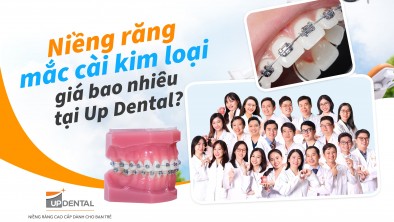 Niềng răng mắc cài kim loại giá bao nhiêu [05/2026] tại Up Dental
