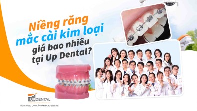 Niềng răng mắc cài kim loại giá bao nhiêu [05/2026] tại Up Dental