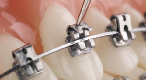 Niềng răng mắc cài kim loại tự đóng/tự khóa
