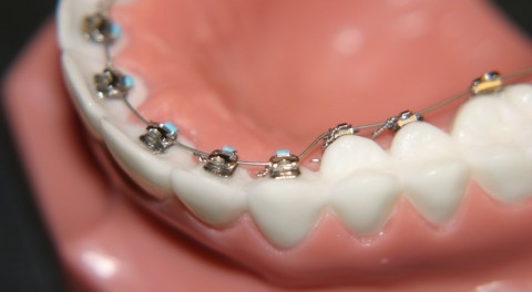Niềng răng hô mất bao lâu cho hiệu quả chỉnh nha tốt nhất?