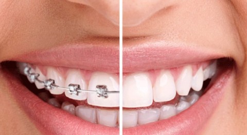 Thời gian niềng răng bao lâu thì có kết quả như mong đợi?