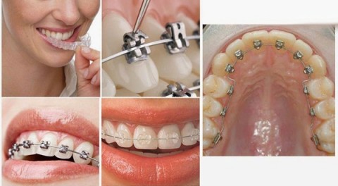 Niềng răng cố định và những thông tin bạn nên biết