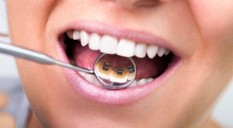 Khám phá các phương pháp niềng răng thẩm mỹ