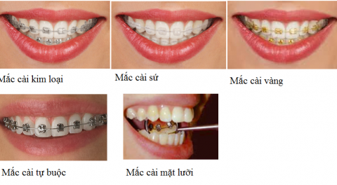 Bảng giá niềng răng và yếu tố quyết định chi phí niềng răng