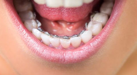 Hé lộ phương pháp niềng răng mặt trong mà nhiều ngôi sao đã áp dụng
