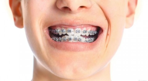 Các loại niềng răng tốt nhất hiện nay
