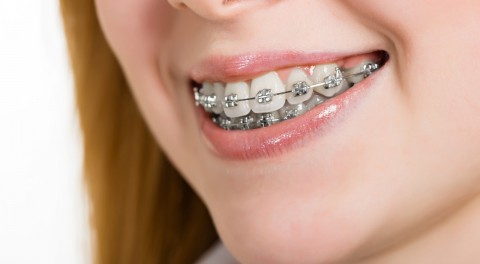 Top 10 kinh nghiệm niềng răng mắc cài bạn không thể bỏ qua