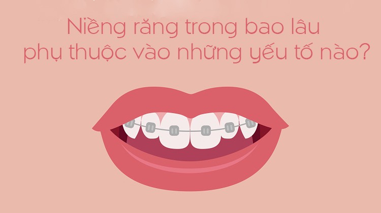 Thời gian niềng răng phụ thuộc vào những yếu tố nào?