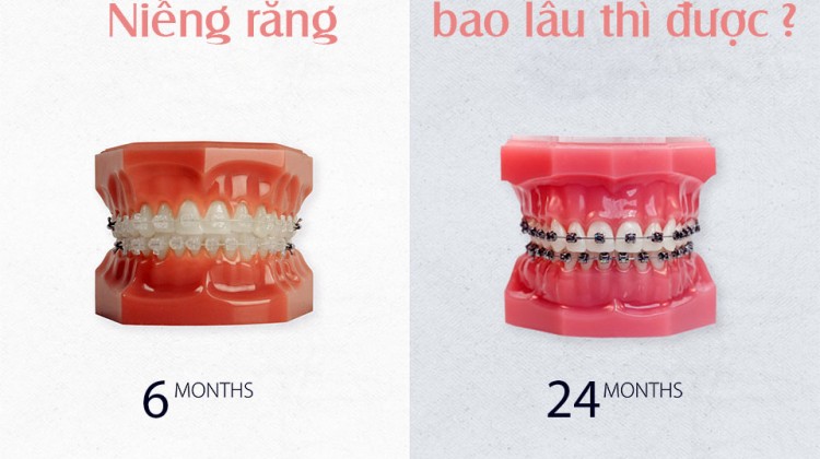 Niềng răng bao lâu thì được kết quả như mong muốn?