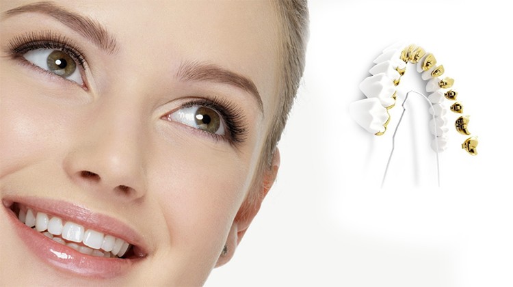 Niềng răng mắc cài mặt trong có hiệu quả không?