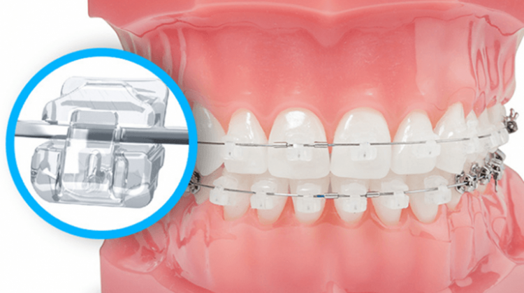 Niềng răng mắc cài sứ tự buộc và những lý do nên lựa chọn