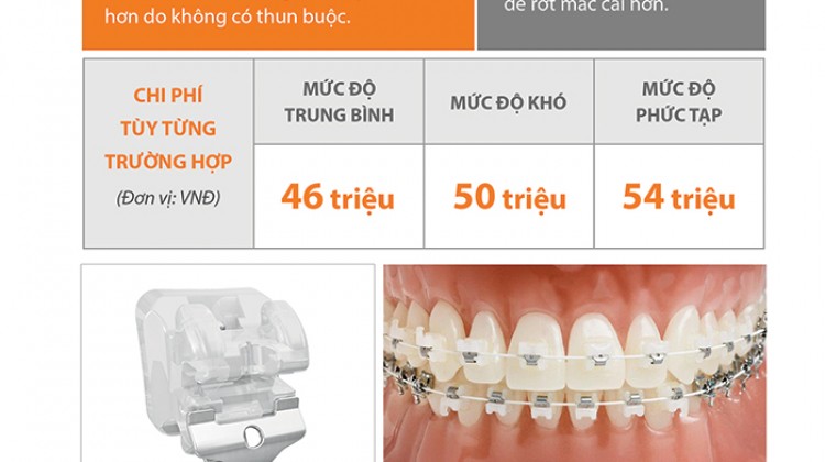 Bảng giá phương pháp niềng răng mắc cài sứ cao cấp tự khóa
