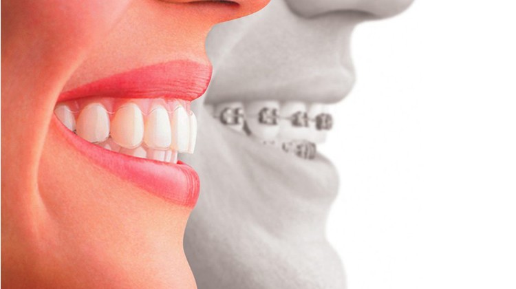 Những điều cần biết về răng hô và phương pháp chữa răng hô