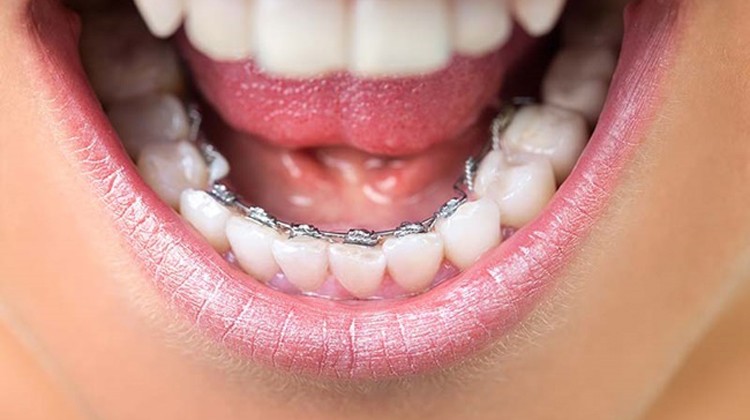 Niềng răng mắc cài kim loại mặt trong