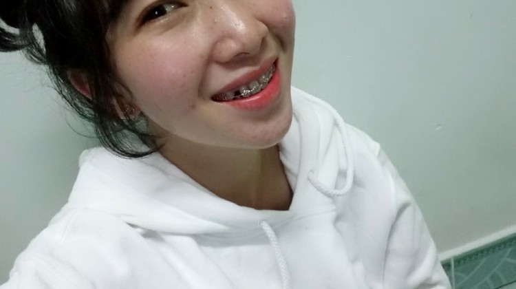 Điều trị răng lệch lạc bằng phương pháp niềng răng