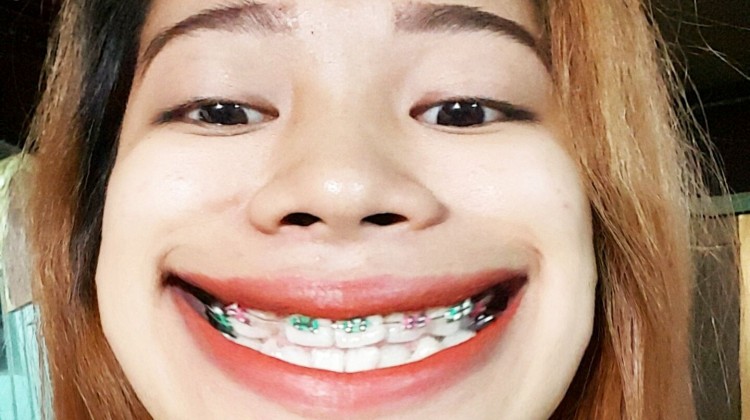 Chia sẻ: Cảm giác khi niềng răng, gắn mắc cài