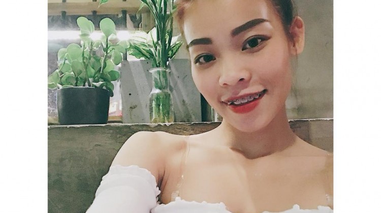 Răng hô lệch lạc và phương pháp điều trị hiệu quả.