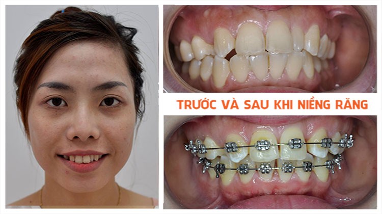 Niềng răng có ảnh hưởng đến hệ thần kinh hay không