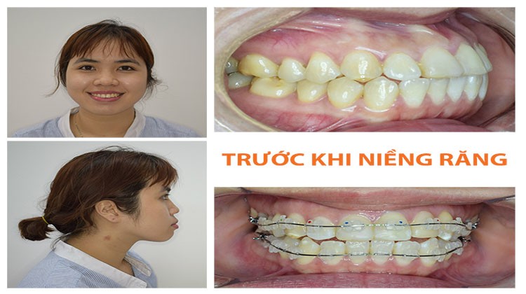 Nha khoa niềng răng chuyên sâu tốt nhất tại Hồ Chí Minh