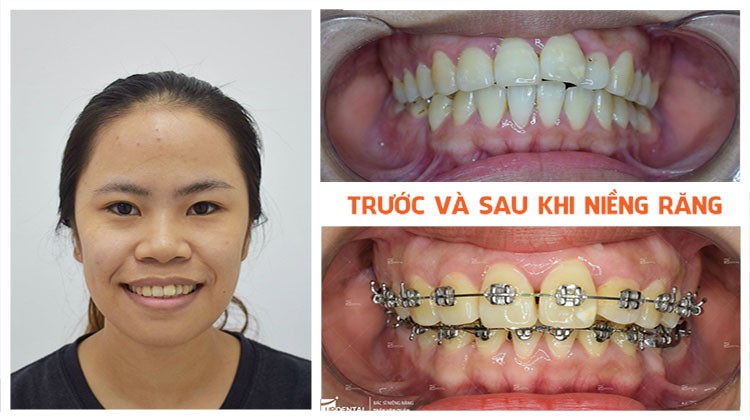 Review kết quả niềng răng tại Nha khoa Up Dental khách hàng Thanh Danh