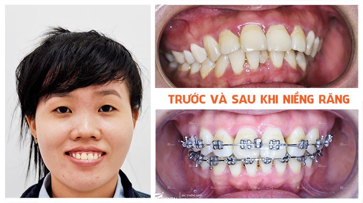 Phương pháp điều trị hô hàm, hô răng tại Nha khoa Up Dental