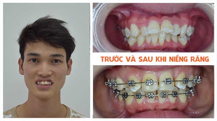 Đẹp lên nhờ niềng răng tại Nha khoa Up Dental Khách hàng Đức Chiển