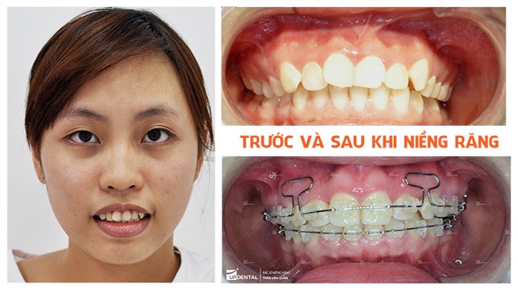Tiêu chí chọn nơi niềng răng uy tín Nha khoa Up Dental khách hàng Quỳnh Trang