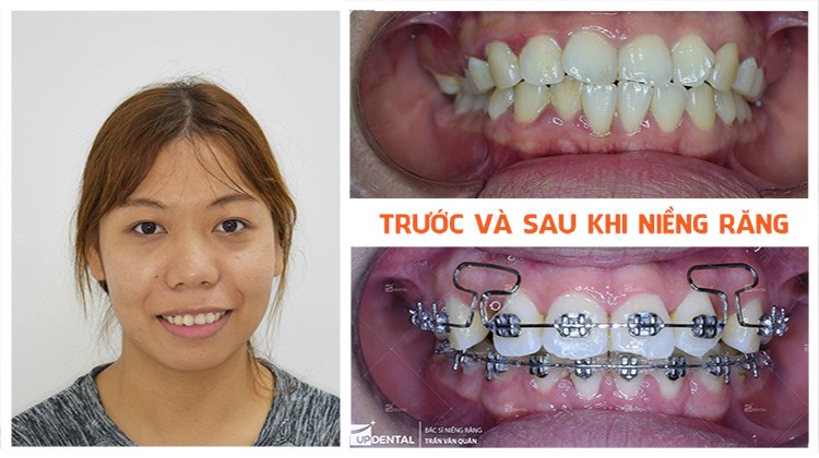 Review niềng răng hô Nha khoa Up Dental khách hàng Thanh Chuyên