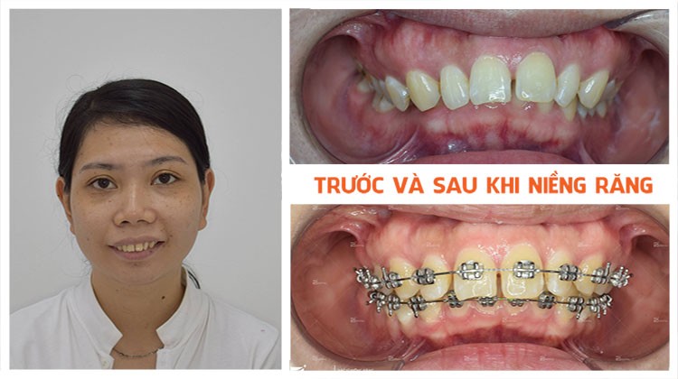 Niềng răng an toàn tại Nha khoa Up Dental khách hàng Thanh Xuân