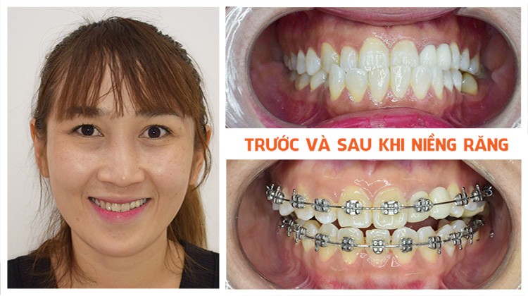 Review niềng răng móm Nha khoa Up Dental khách hàng Thanh Trúc