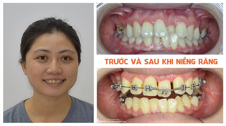 Niềng răng mắc cài kim loại tại Nha khoa Up Dental khách hàng Minh Nga
