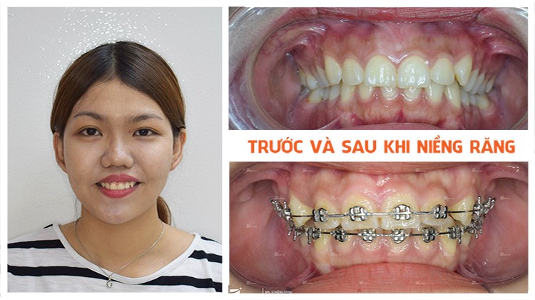 Điều trị cười hở lợi tại Nha khoa Up Dental khách hàng Lan Thanh