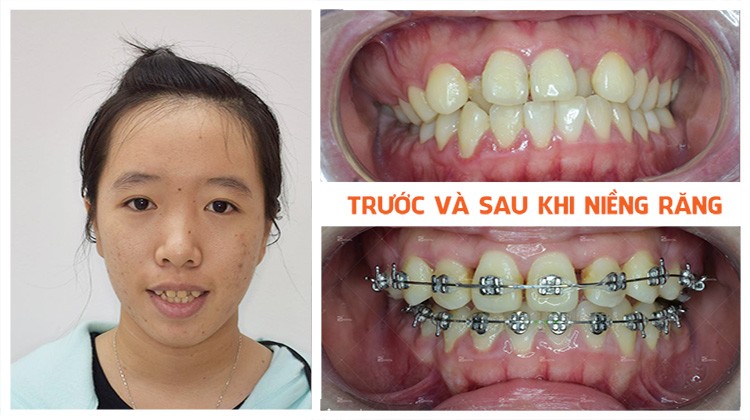 Review niềng răng Nha khoa Up Dental khách hàng Thanh Vân