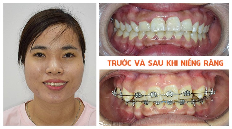 Niềng răng ở đâu tốt và kinh nghiệm của khách hàng Nguyễn Thị Thảo