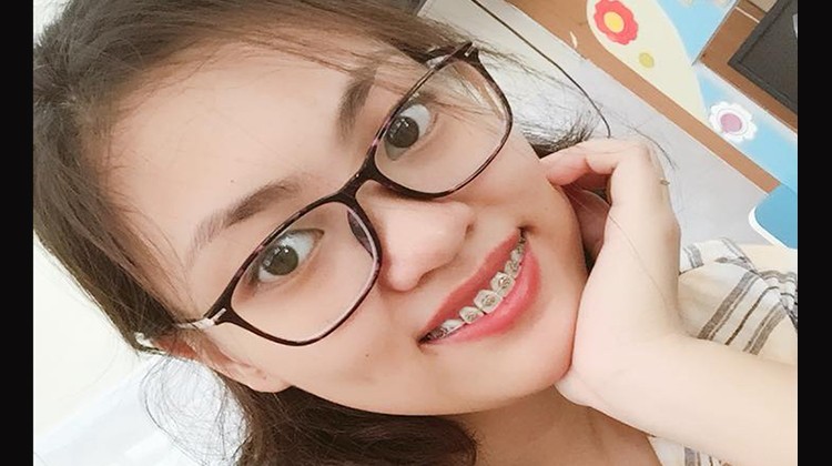 Review kết quả niềng răng thưa, răng hô tại Nha khoa Up Dental