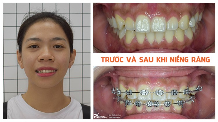 Chi phí niềng răng - niềng răng trả góp